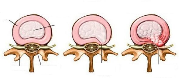 椎骨骨软骨病椎骨疝