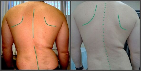 脊柱的曲率有骨软骨病