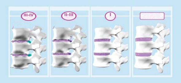颈骨骨软骨病的阶段
