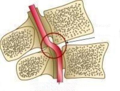 驱动动脉综合征