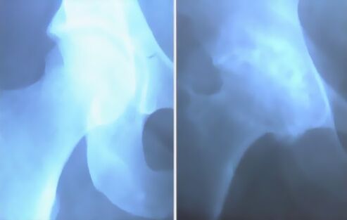 膝关节关节炎的浮渣